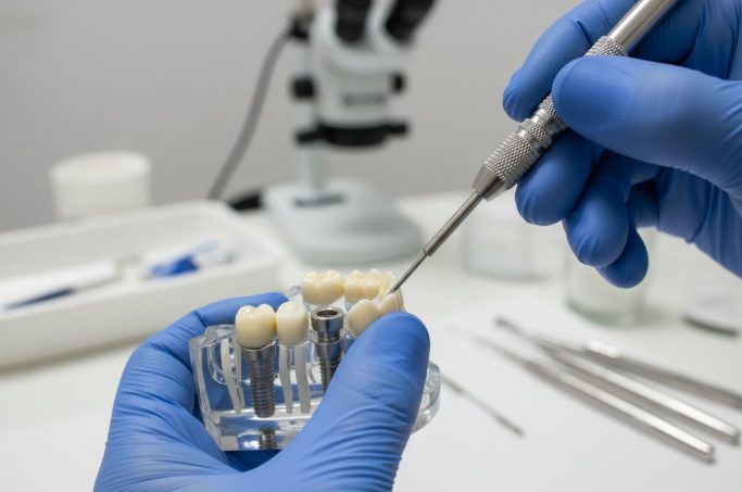 What Is the 3/2 Rule for Dental Implants?