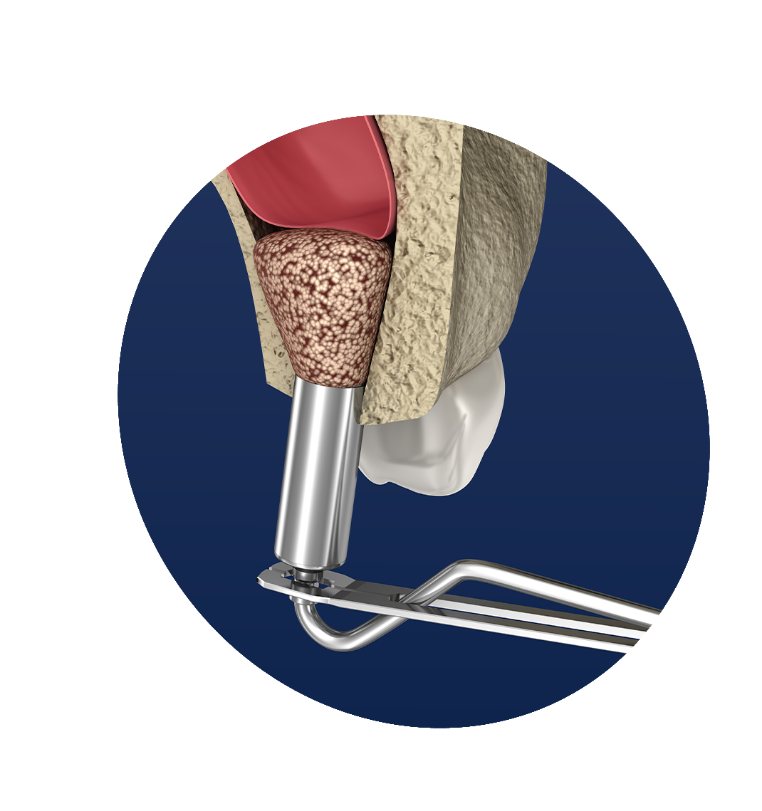 dental implants bucktown chicago